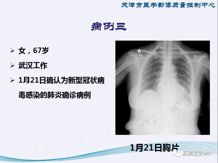 全球新型肺炎疫情進展及應(yīng)對策略，最新情況與全球視野