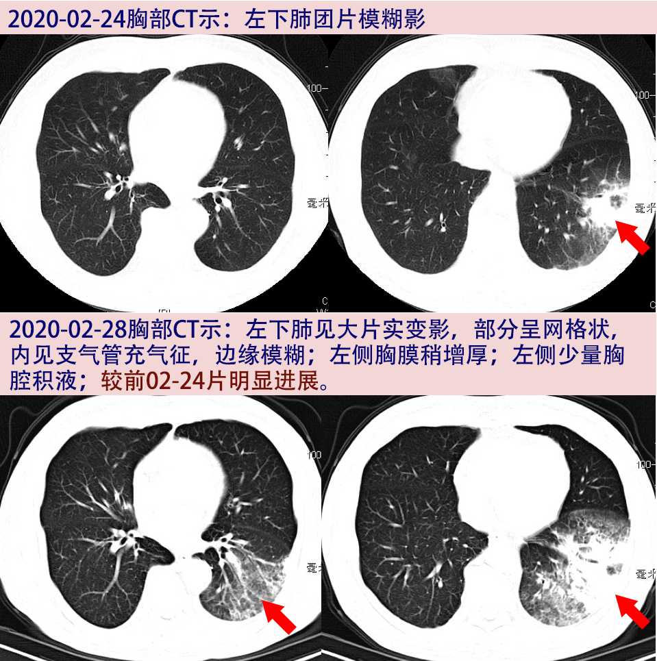 全球新冠肺炎感染挑戰(zhàn)與應(yīng)對(duì)策略最新進(jìn)展